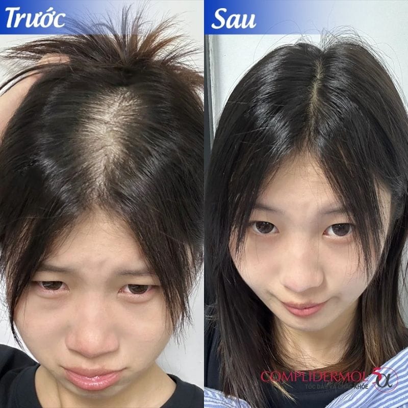 Hiệu quả sử dụng viên uống rụng tóc Complidermol 5 Alpha cho phụ nữ sau sinh
